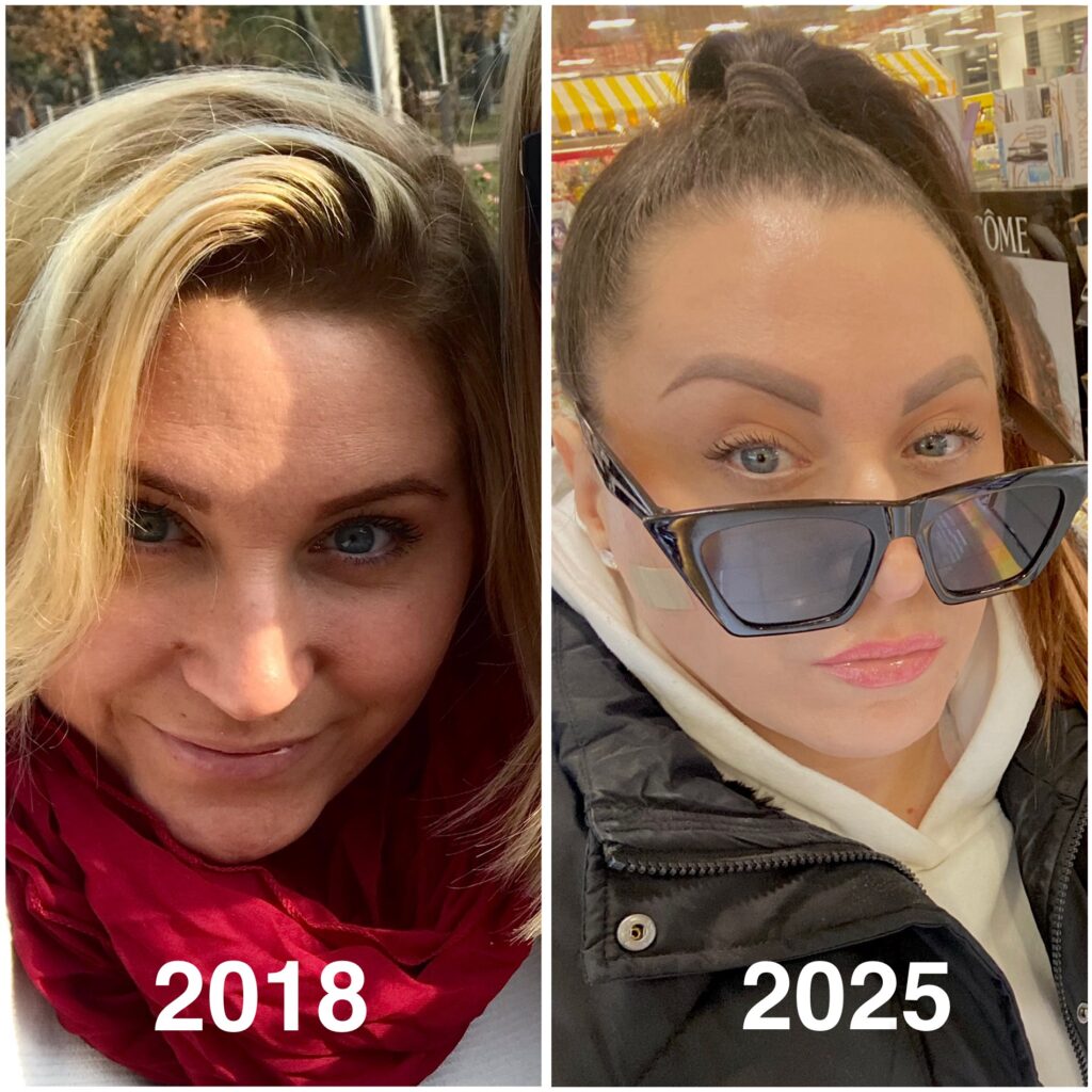 before and after resoults from consistent skincare routine natural glow without injections