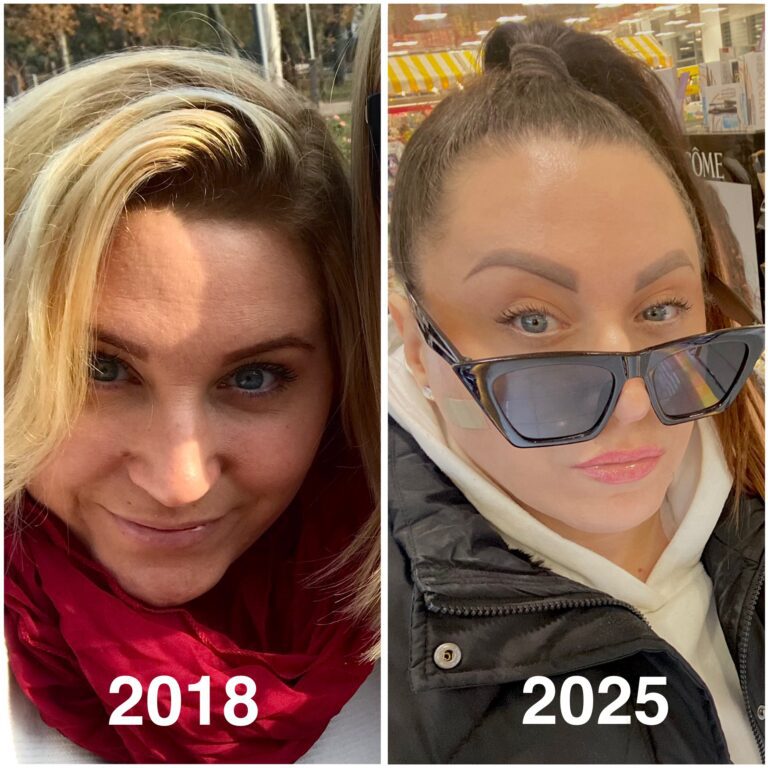 skin transformation 2018 vs 2025 consistent skincare routine natural glow no injection