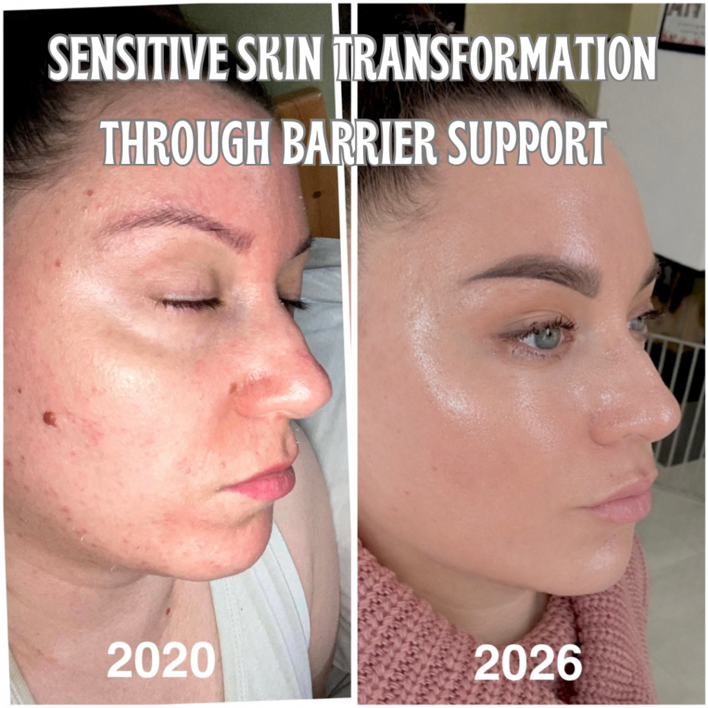 Sensitive skin transformation with hydration, barrier support and consistent skincare routine