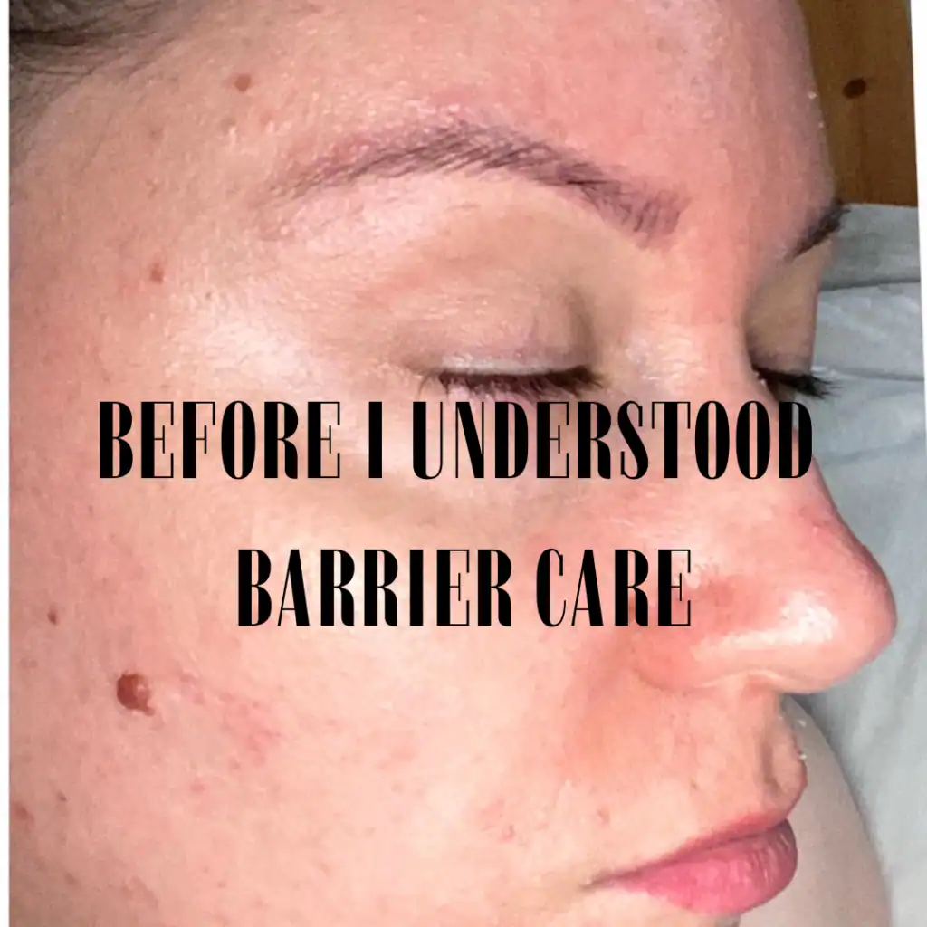 close up of damaged skin barrier before starting a skin longevity skincare routine