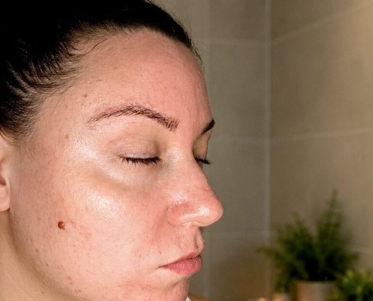 Dehydrated skin showing redness, irritation and signs of a damaged skin barrier