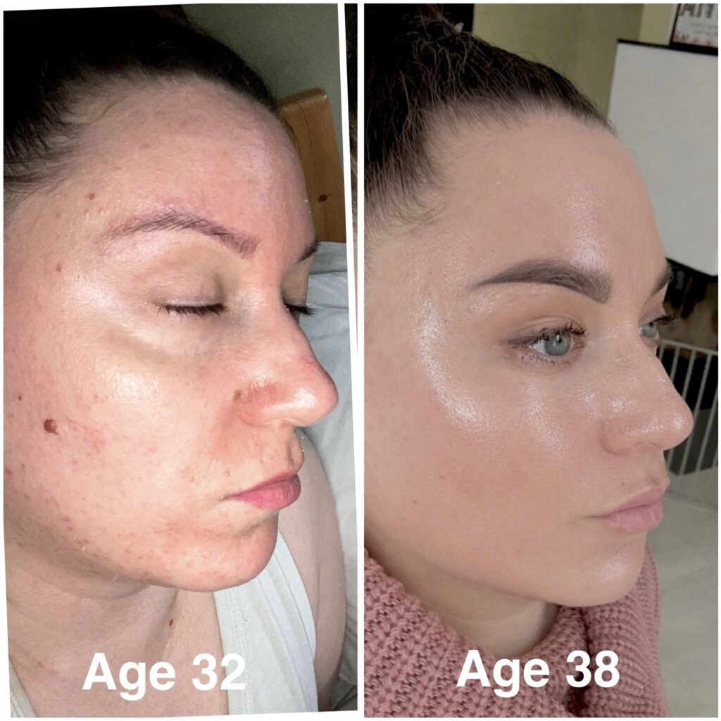 Before and after skin transformation after focusing on hydration and skin barrier support